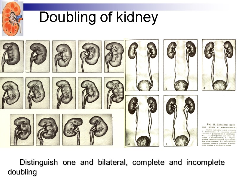 Doubling of kidney Distinguish one and bilateral, complete and incomplete doubling
